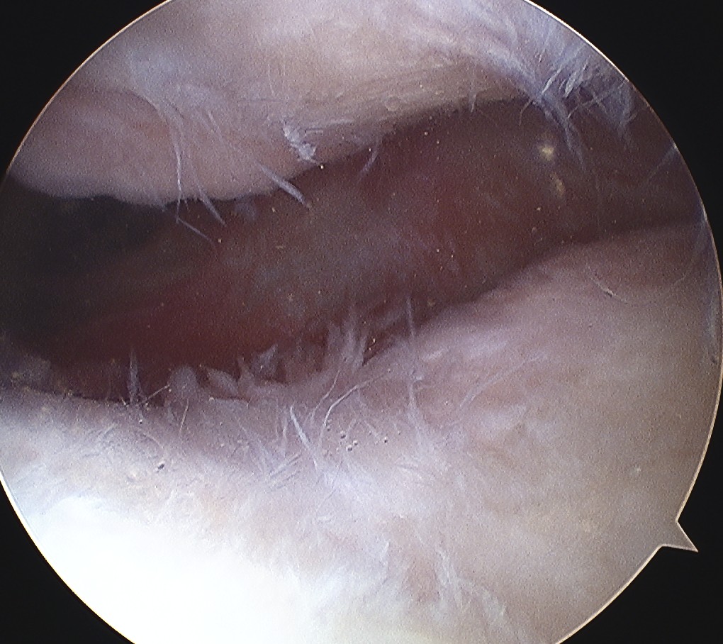 PFJ OA Arthroscopy